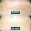 Apricot Stirn Pad mit Hyaluron fantastic forehead - 4