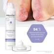 Allpresan psoriatix Schaumcreme f. extrem schuppige, juckende, ger&ouml;tete Haut - 4