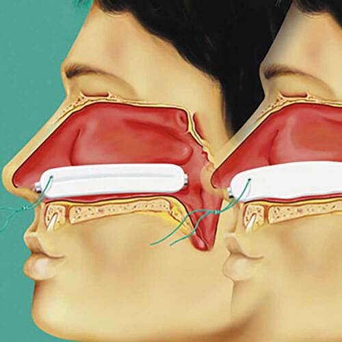 Raucocel Nasentamponade gera - 3