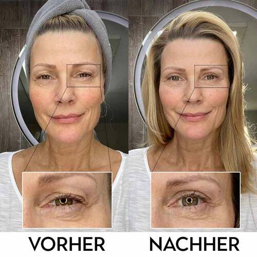 Lidperfect Augengel bei Schlupflidern - 3