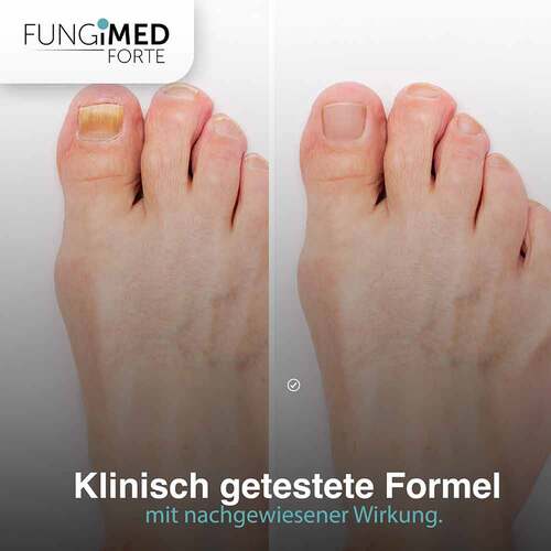 Fungimed Forte Nagellack gegen Nagelpilz - 5