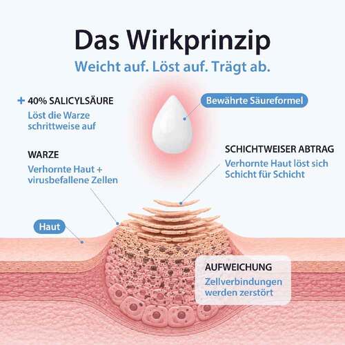 Acetocaustin Warzenpflaster - 4